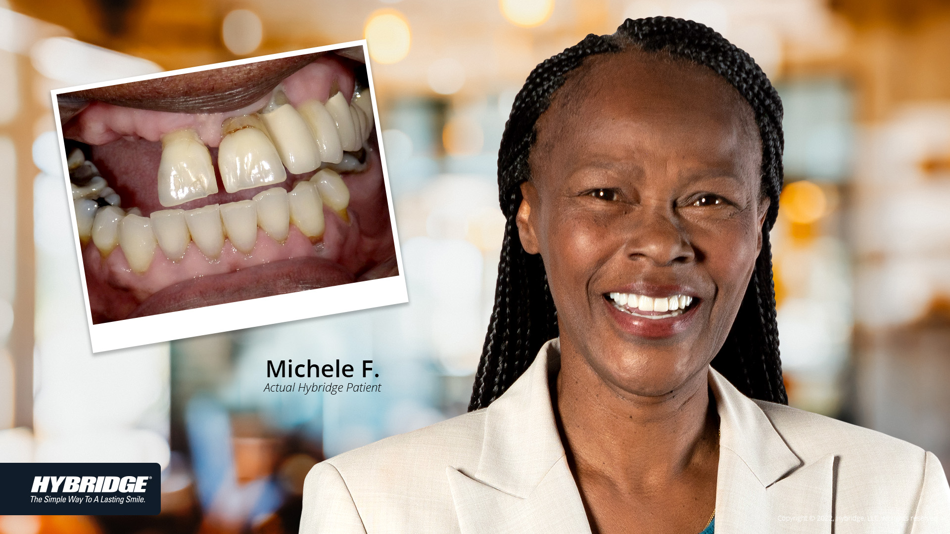 Before-After_Smile_Gallery_Michelle-F