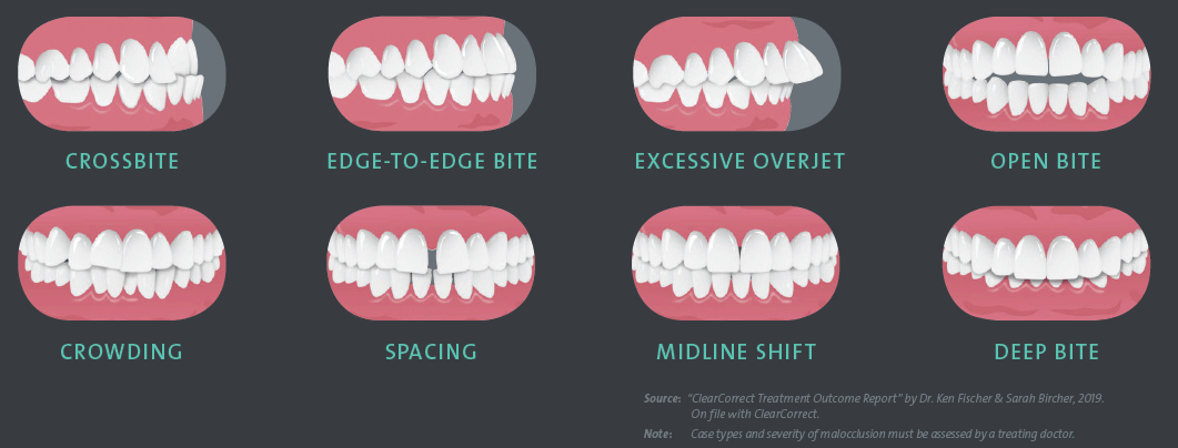 ClearCorrect Case Types