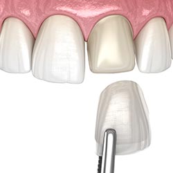 Dental crowns and restored strength and support